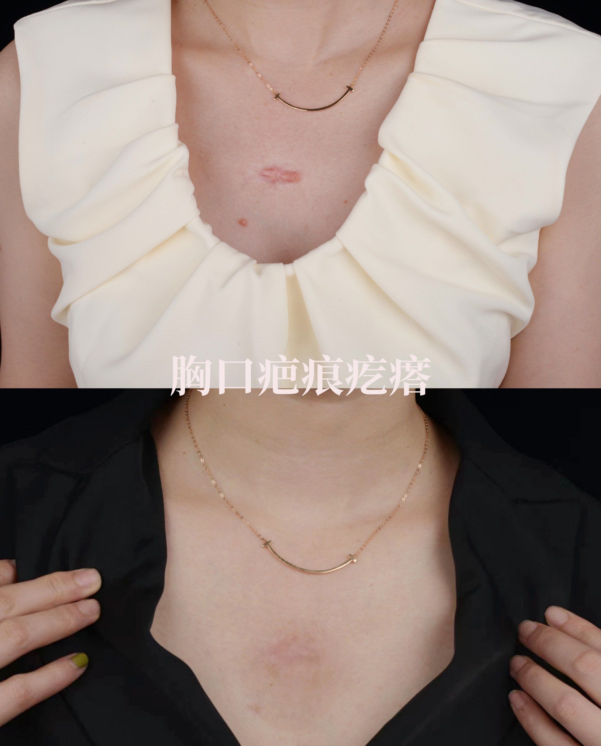 胸口疤痕增生,治疗效果分享