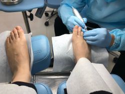 -派恩宜灰指甲鸡眼嵌甲手足癣