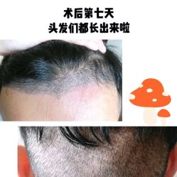 -碧莲盛·不剃发植发