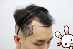 -大麦微针植发丨全国连锁