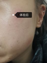 体验后-正璞医疗美容·皮肤修复·微整注射