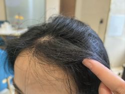 -碧莲盛·不剃发植发