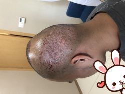 点击看大图 -大麦微针植发丨全国连锁