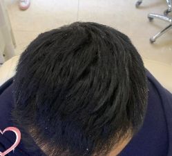 -大麦微针植发丨全国连锁