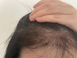 -碧莲盛·不剃发植发