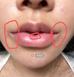 体验后-杭州米兰柏羽医疗美容医院