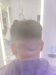 体验后-大麦微针植发全国连锁