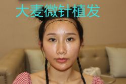 -大麦微针植发丨全国连锁