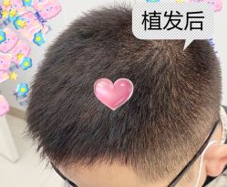 -大麦微针植发全国连锁