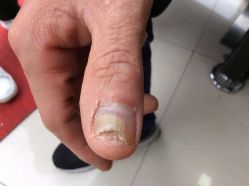 点击看大图 -德哥灰指甲脚气甲沟炎跖疣护理