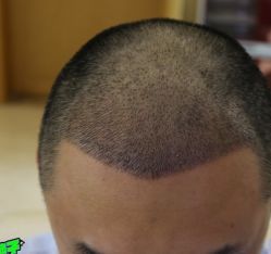 -大麦微针植发丨全国连锁