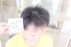 点击看大图 -大麦微针植发丨全国连锁