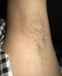 -薇兰专业脱毛连锁机构