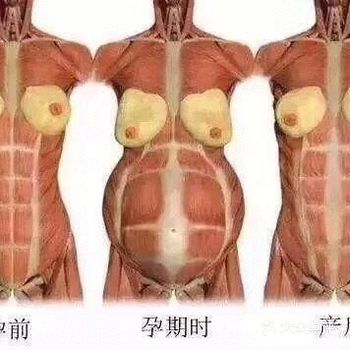 腹直肌分离其实是有两个概念
