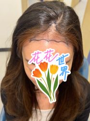 -大麦微针植发全国连锁