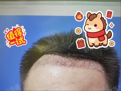 -碧莲盛·不剃发植发