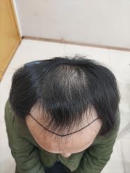 -大麦微针植发丨全国连锁