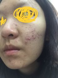 -苗方清颜专业祛痘连锁机构