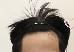 -大麦微针植发全国连锁