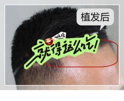 -大麦微针植发全国连锁