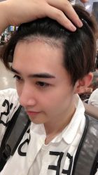 点击看大图 -大麦微针植发丨全国连锁