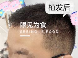 -大麦微针植发全国连锁