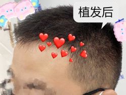 -大麦微针植发全国连锁