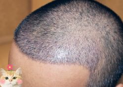 -大麦微针植发丨全国连锁