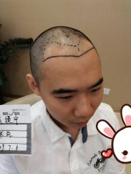 点击看大图 -大麦微针植发丨全国连锁