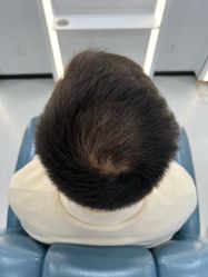 -大麦微针植发全国连锁