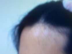 体验前-雍禾植发全国连锁