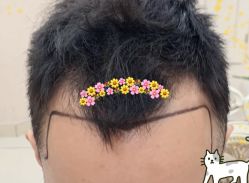 -大麦微针植发全国连锁