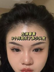 -碧莲盛·不剃发植发