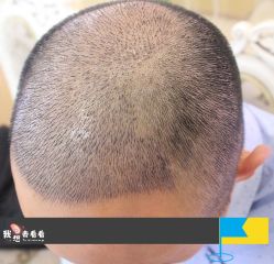 -大麦微针植发丨全国连锁
