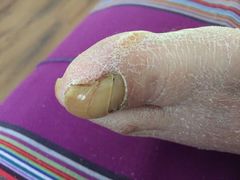 -祖传修脚甲沟炎灰指甲鸡眼