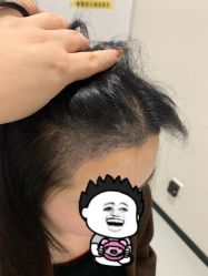 -大麦微针植发全国连锁