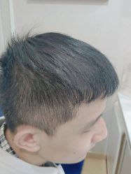 体验后-熙朵美学植发连锁