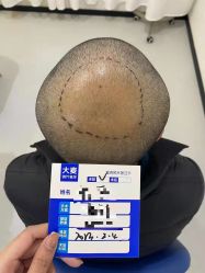 -大麦微针植发全国连锁