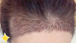 -大麦微针植发丨全国连锁