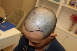 -大麦微针植发丨全国连锁