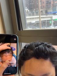 点击看大图 -碧莲盛·不剃发植发