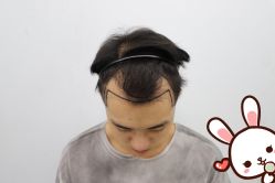 点击看大图 -大麦微针植发丨全国连锁