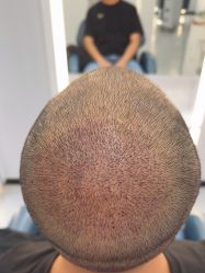 -大麦微针植发全国连锁