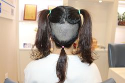 -大麦微针植发丨全国连锁