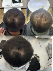 体验后-大麦微针植发全国连锁