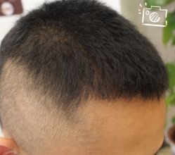 -大麦微针植发丨全国连锁