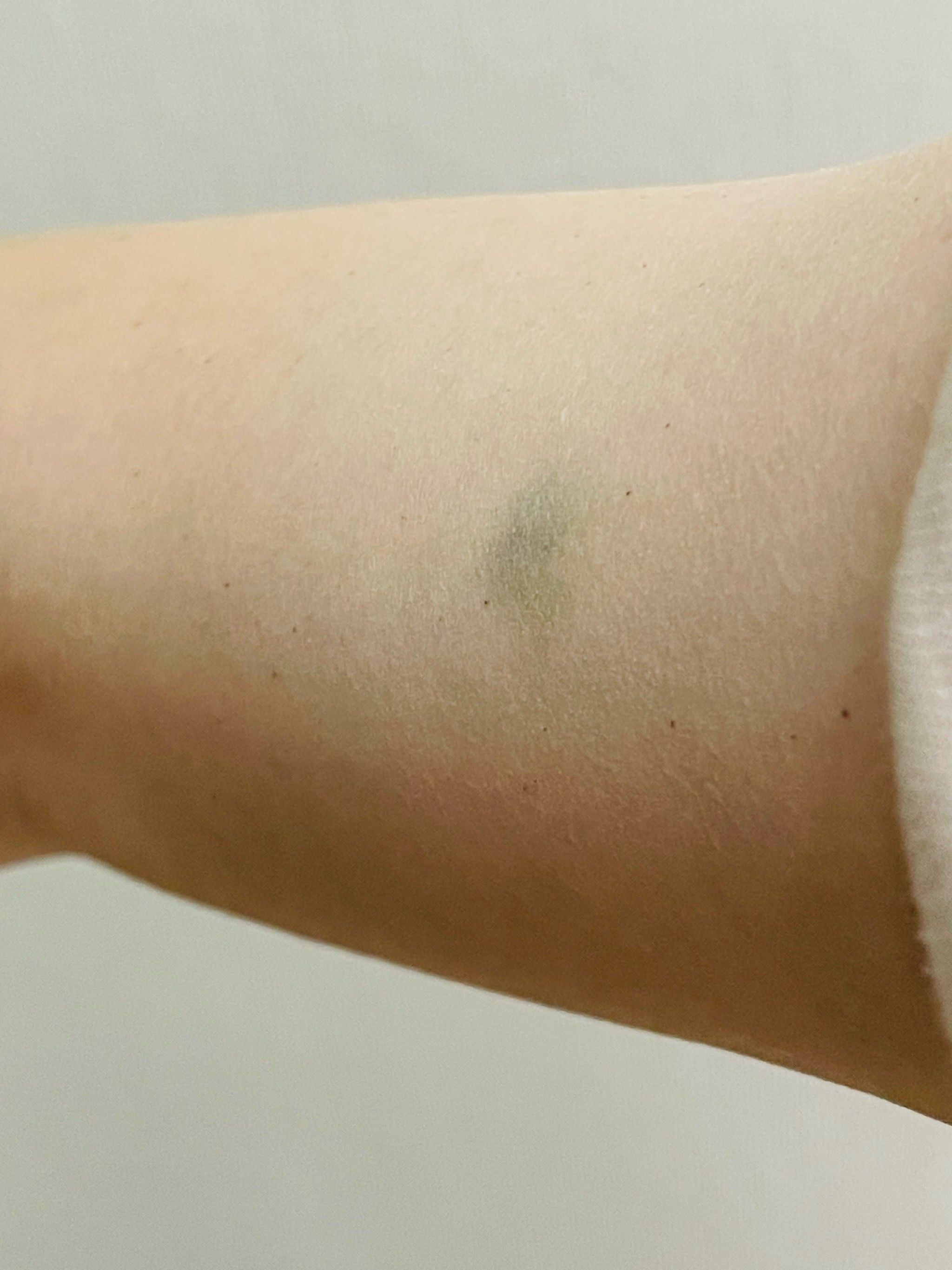 推拿完毕 全身淤青