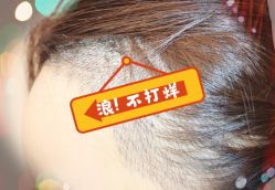 -大麦微针植发全国连锁