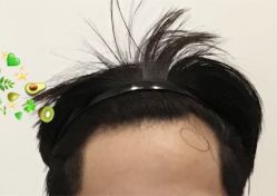 -大麦微针植发全国连锁