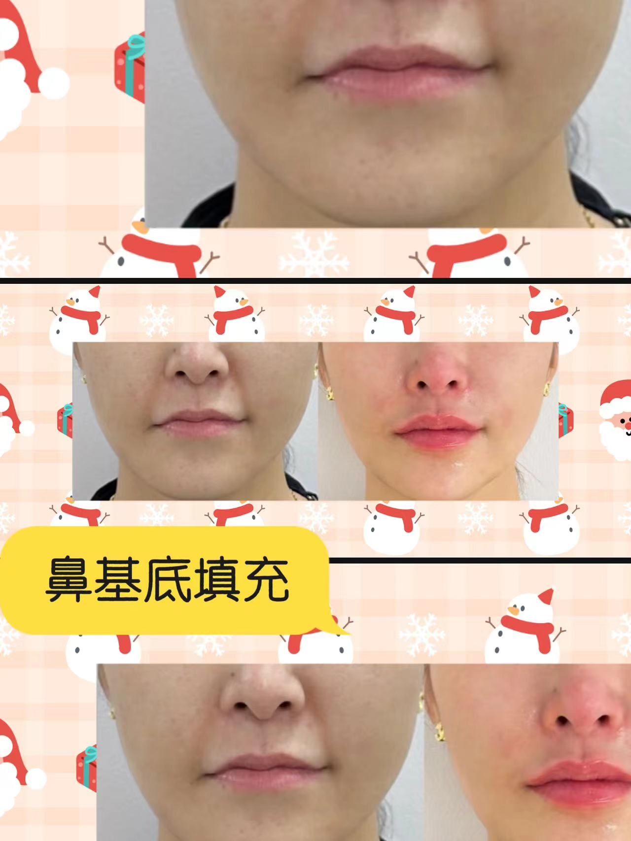 玻尿酸填鼻基底干货分享